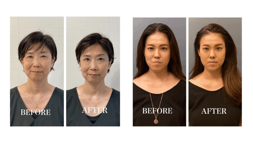 ドライ炭酸ヘッドスパ施術前後のお客様の写真（ビフォーアフター）